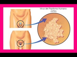 Virus del Papiloma Humano en hombre