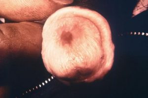 Virus del Papiloma Humano en hombre