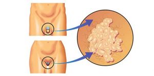 Virus del Papiloma Humano en hombre